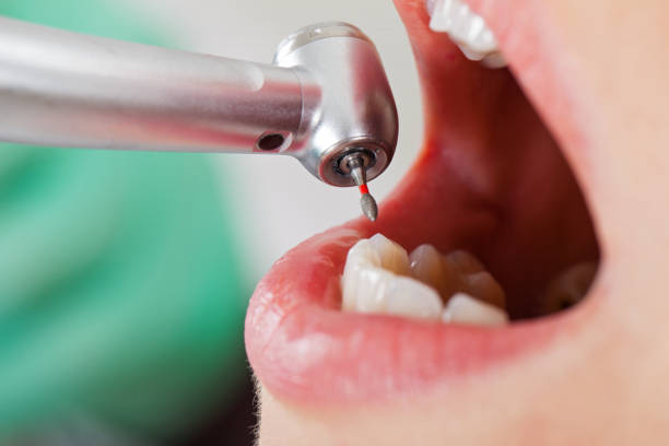 Best Emergency Root Canal Therapy in Bellevue, NE